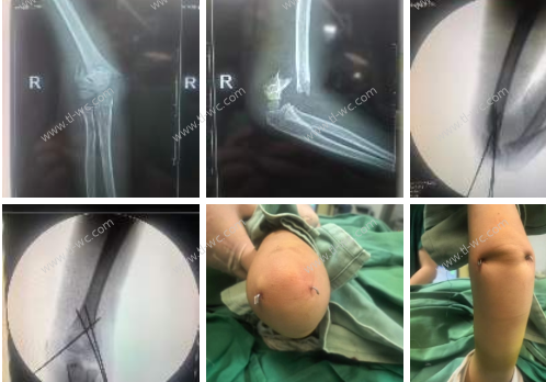 Late-night emergency: For the sake of the child, we chose minimally invasive surgery