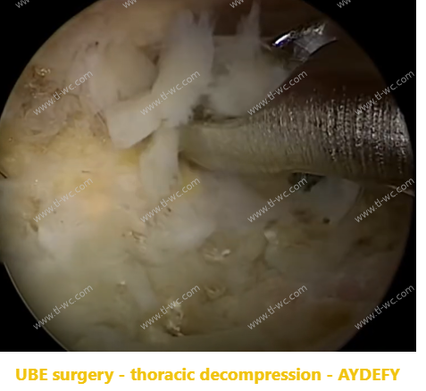 Management of the inferior articular process in revision surgery of parasppinal ExTLIF